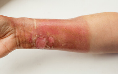Close-up of a woman's hand with a burned skin of boiling water. Burn treatment theme. Red dead skin of the hands after a thermal burn. Selective focus