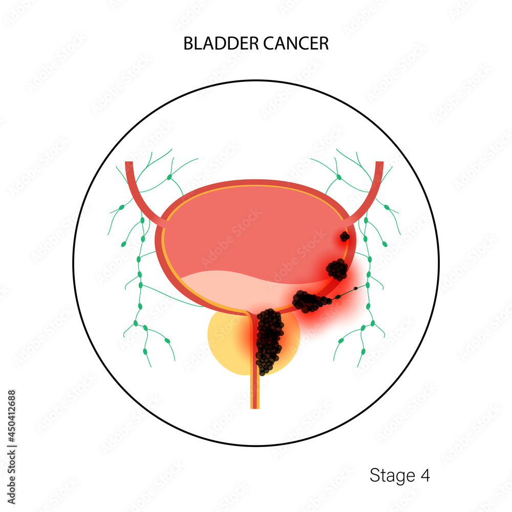 Wall mural Bladder cancer stages