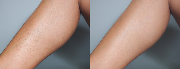 Image before and after leg hairs removal concept.
