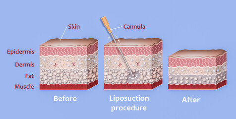 Mechanism of liposuction. Suction-assisted liposuction. Hollow tube or cannula, which is inserted through a small incision in the skin in order to fat suctioned out of the body