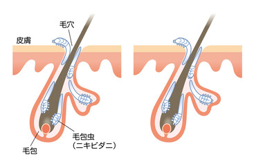 毛包虫　ニキビダニ　皮膚　毛穴　毛根