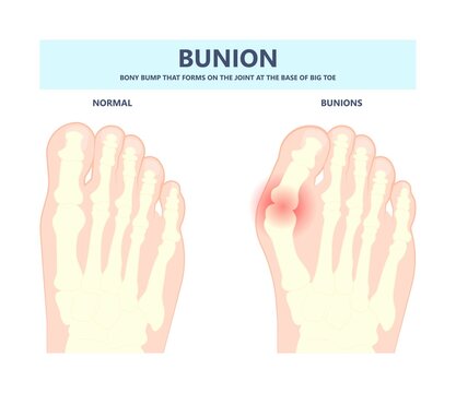 Bony Bump Joint Big Toe Bone Enlarge Fifth Foot Pain Shoe Tailor Swollen Feet Wearing Poor Fitting High Heel Inversion Lump Bursa Hammer Bend Tendon Stress Injury Gout Spur Callus Corn Turf Flat Feet