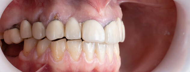 press ceramic crowns and veneers bl2