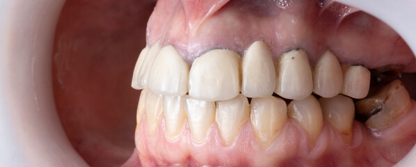 press ceramic crowns and veneers bl2