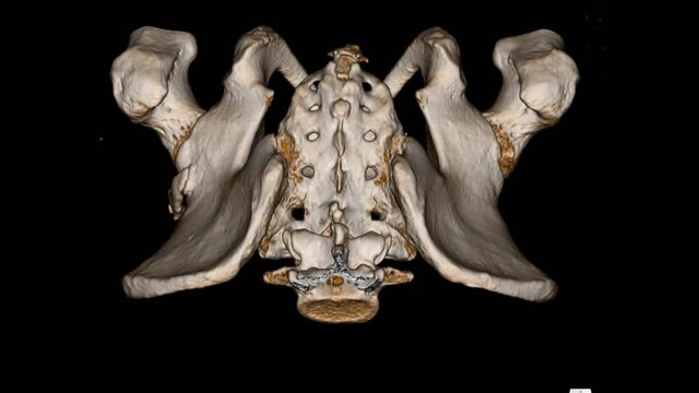 CT Pelvis Bone 3D rendering image isolated on a black background showing: Myositis ossification at muscle superolateral to the right acetabulum.