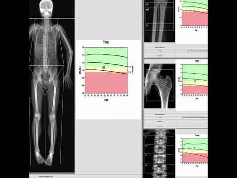 Special examination of bone density. Result Osteoporosis too blurriness and artifacting image when viewed at full resolution,
