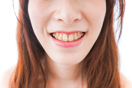 歯列矯正をする若い女性