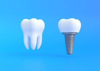 White tooth and dental implant on a blue background. Concept of dental examination teeth, dental health and hygiene. 3d render illustration