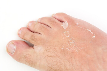 Man's legs are seriously sun-burnt on white background. sunburned skin on a man's legs. Skin care and UV protection concept