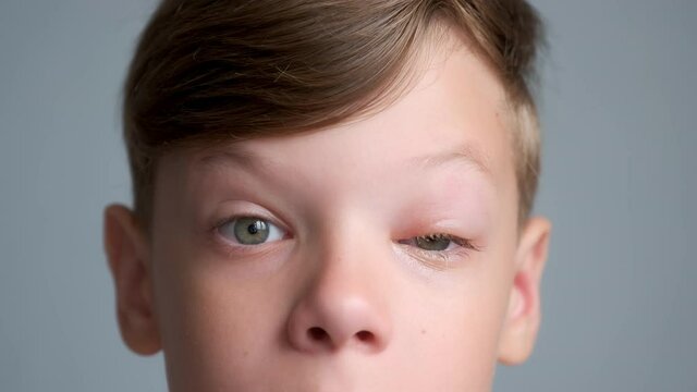 Face of boy with a swollen eye from an insect bite, closeup view. Allergy to insect bites. Closed red sick eye of a teen boy. Eye disease in a child, conjunctivitis, inflammation in the eye.