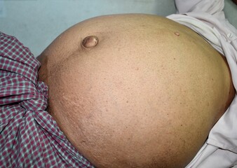 Abdominal fat in patient with ascities and paraumbilical hernia.