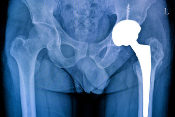 X-ray film of a patient with total left hip replacement.