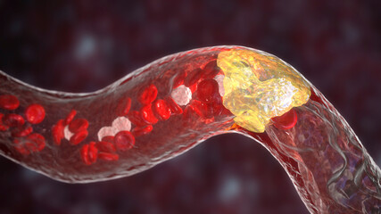 Atherosclerosis, atheromatous plaque inside artery - obrazy, fototapety, plakaty