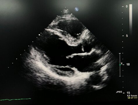 Transthoracic echocardiogram (TTE)  of parasternal long axis view.