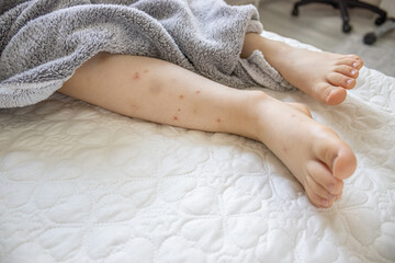 Child's legs with a lot of hair, bruises, with many red spot, wounds from scratches and scars from insect bite, mosquitos and fleas. Kid's legs are on a bed coverlet and the nails are uncut.