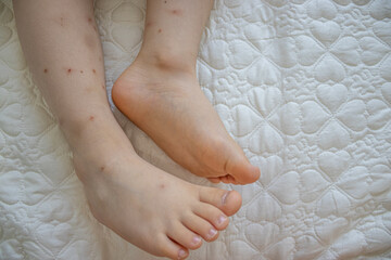 Child's legs with a lot of hair, bruises, with many red spot, wounds from scratches and scars from...