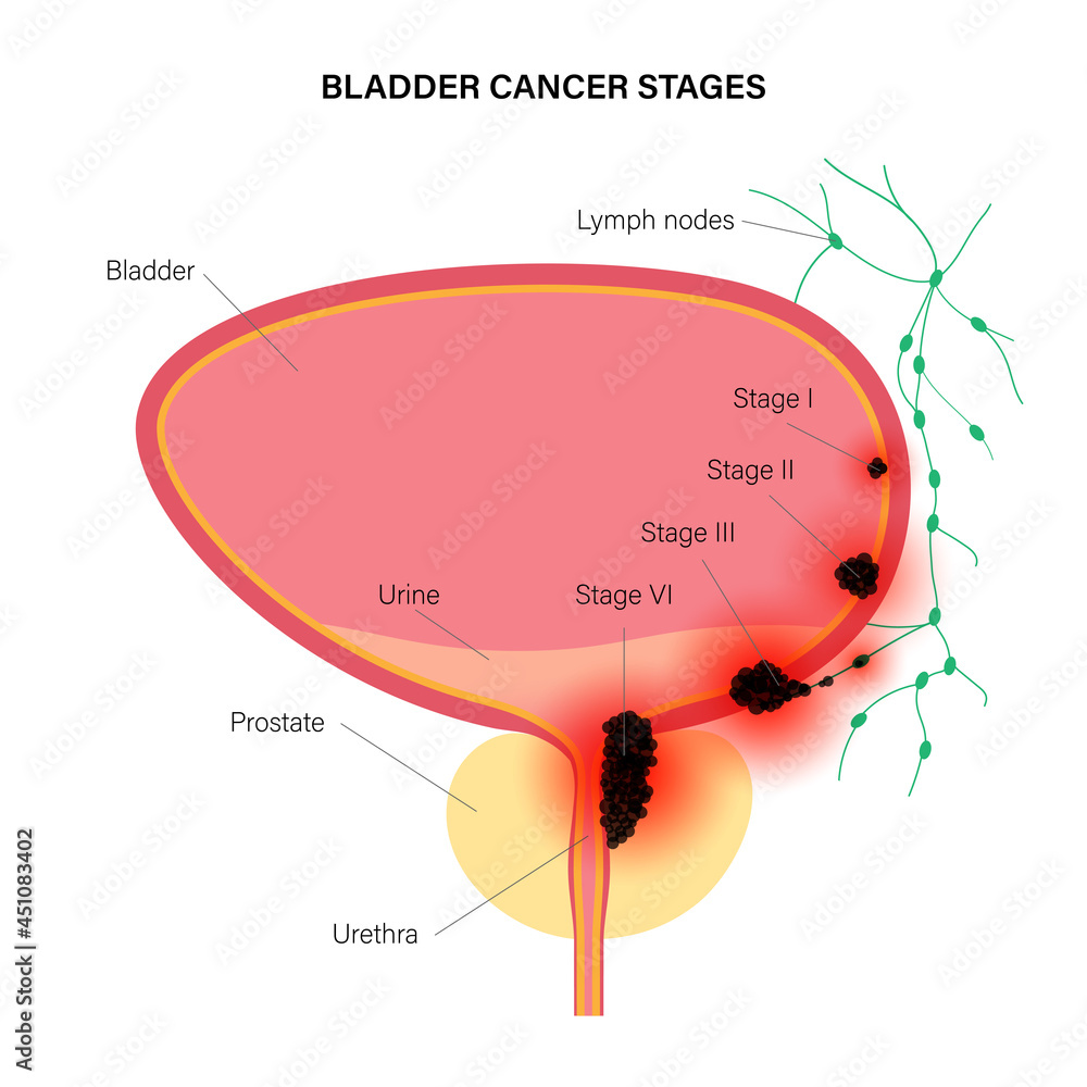 Wall mural Bladder cancer stages