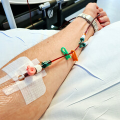 Cannula in arm in preparation for intravenous iron infusion