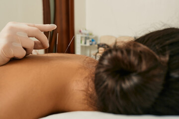 Obraz na płótnie Canvas Reflexology. Treatment of back pain and tightness with acupuncture needles for a female patient