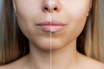Cropped shot of young women's face with lips before and after lip enhancement. Injection of filler...