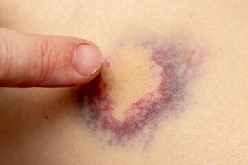 Fototapeta premium The man points a finger at the hematoma. Hematoma on the leg