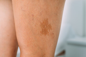 Large birthmark on the leg of a caucasian person