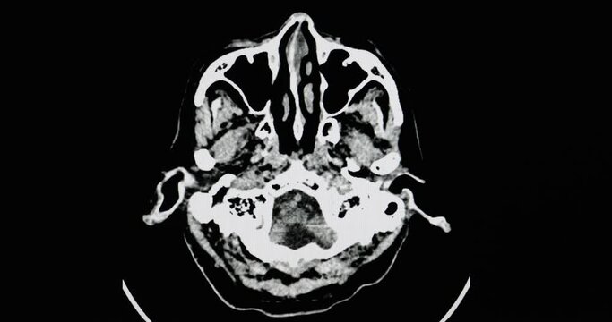 CT brain scan of a brain of a patient with acute lacuna infarction in the left caudate nucleus and chronic cerebral infarction of the right frontal lobe.