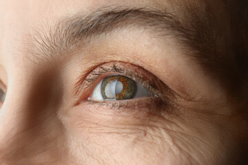 Closeup view of mature woman with cataract - obrazy, fototapety, plakaty