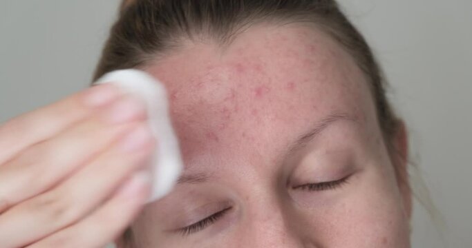 Close up of woman forehead with problematic skin and acne applying skin care product with cotton pad.
