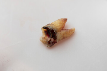 Doctor holding tooth decay extracted from the patient's mouth