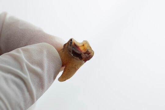 Doctor holding tooth decay extracted from the patient's mouth