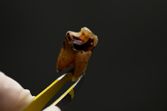 Doctor holding tooth decay extracted from the patient's mouth