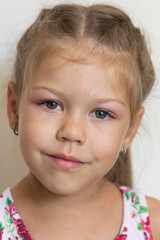 Portrait of caucasian little girl of five years old with swelling eyes because of allergy, conjunctevitis and adenoids