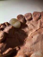 Tooth for dental crown placement.