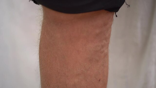 Varicose Veins And Age Spots On The Human Leg. 