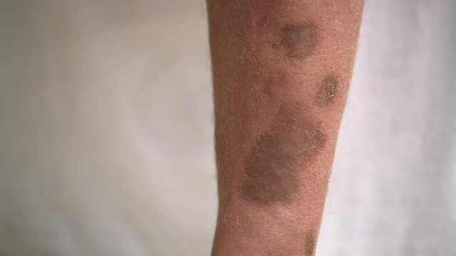 Pigmented spots and ulcers on a person's leg