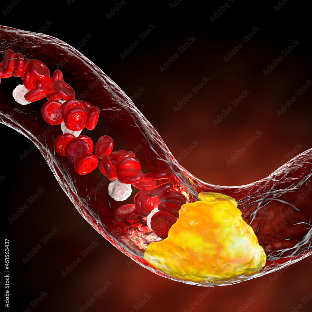 Canvas Prints atherosclerosis, atheromatous plaque inside artery