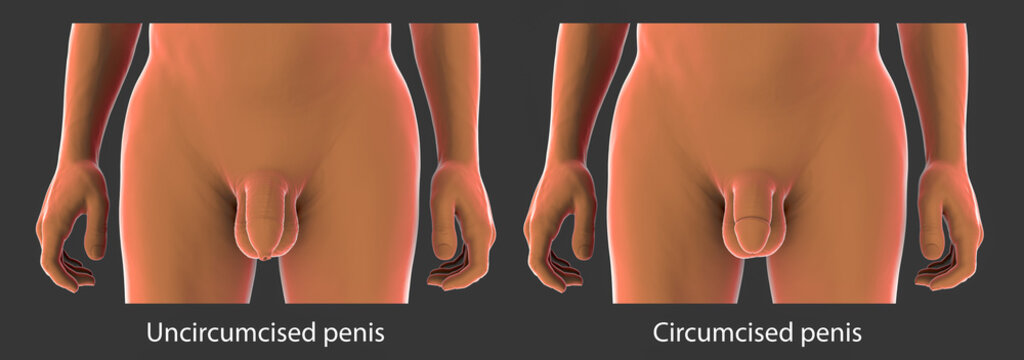 Circumcised and uncircumcised penis, illustration