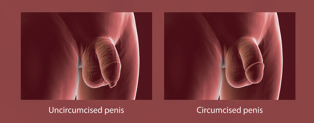 Circumcised and uncircumcised penis, illustration