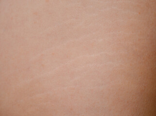 Detailed view of stretch marks on the thigh and the texture of human skin.