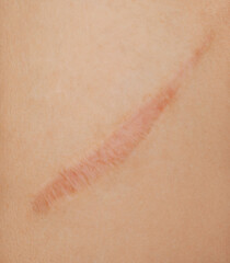 Healed scar on a person's thigh after an injury. Detailed view of the texture of the skin.