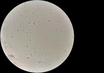 Sperm or semen test or analysis. Azoospermia with plenty pus cells seen. infertily. no sperm
