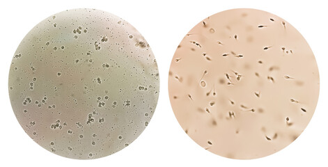 Sperm or semen test or analysis concept photo. Two collage of microphotograph, one is showing Azoospermia with plenty pus cells another Normospermia