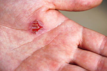 Fototapeta premium Close-up of callus on human hand, rubbing on skin close-up. Skin problems. Palm with Calluses. Hard Work Concept. Blisters on the Injured Hand