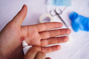 Young man hand applying medical ointment on thumb after burn, corns and calluses. First aid. Self help. Medical concept. Closeup. 