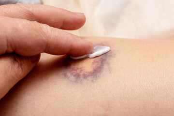 Applying ointment on the hematoma. Hematoma treatment