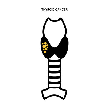 Thyroid cancer stages