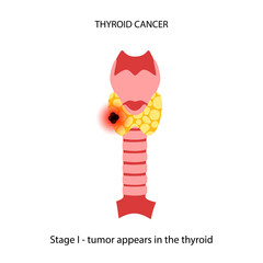 Thyroid cancer stages