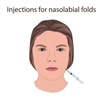 Injections for nasolabial folds, illustration