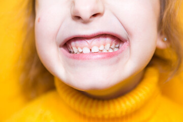 Girl shows her teeth-pathological bite, malocclusion, overbite. Pediatric dentistry and...